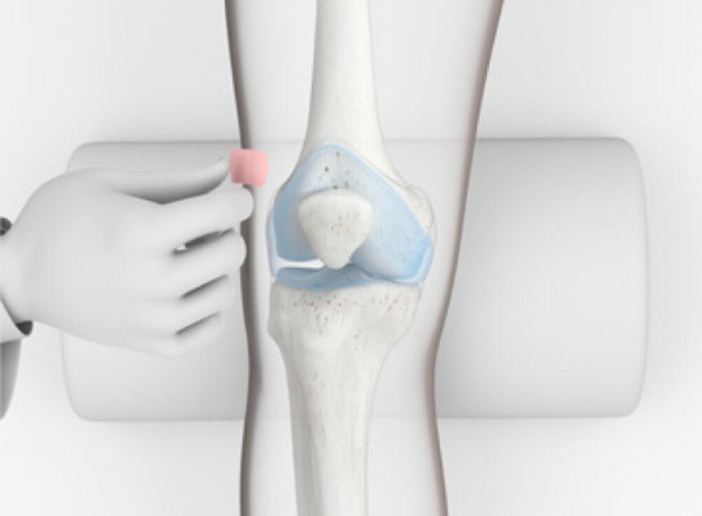Illustration of a knee joint showing where the Arthrosamid® gel is injected