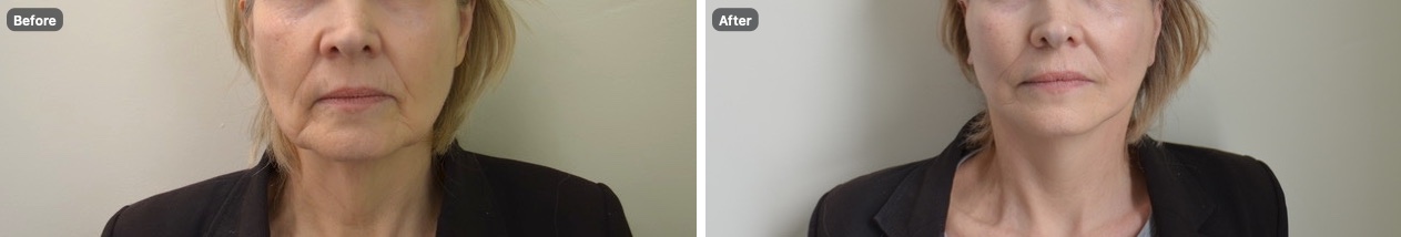 Front view of a patient’s lower face and neck before and after an Apex Facelift®