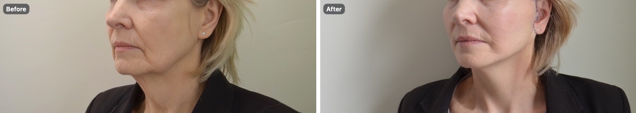 Side view of the same patient’s jawline and neck before and after an Apex Facelift®
