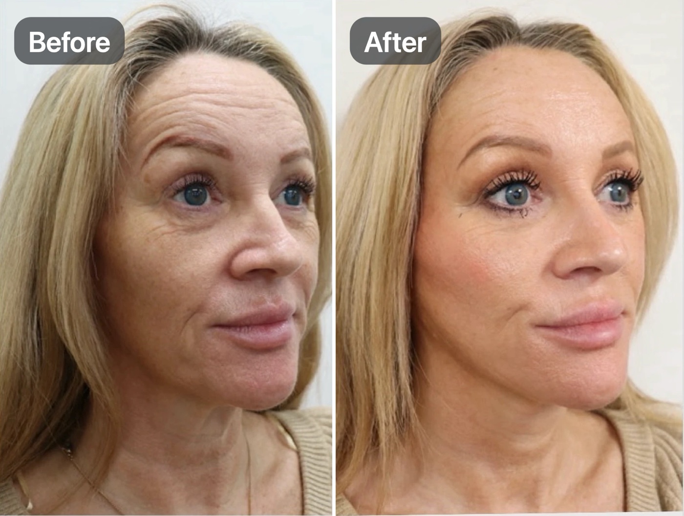 Three-quarter view of a woman’s face and neck before and after an Apex Facelift®