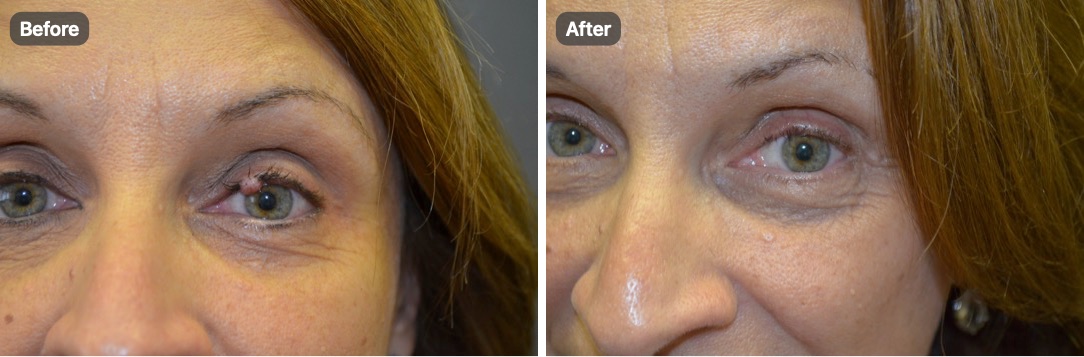 A patient’s eyes before and after removal of a small lesion on the upper eyelid margin
