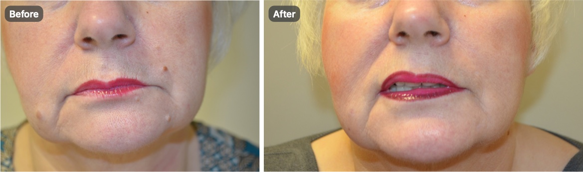 A patient’s lower face before and after removal of several small moles