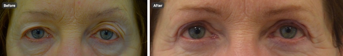 A patient’s eyes before and after upper eyelid surgery, showing less hooding of the upper lids