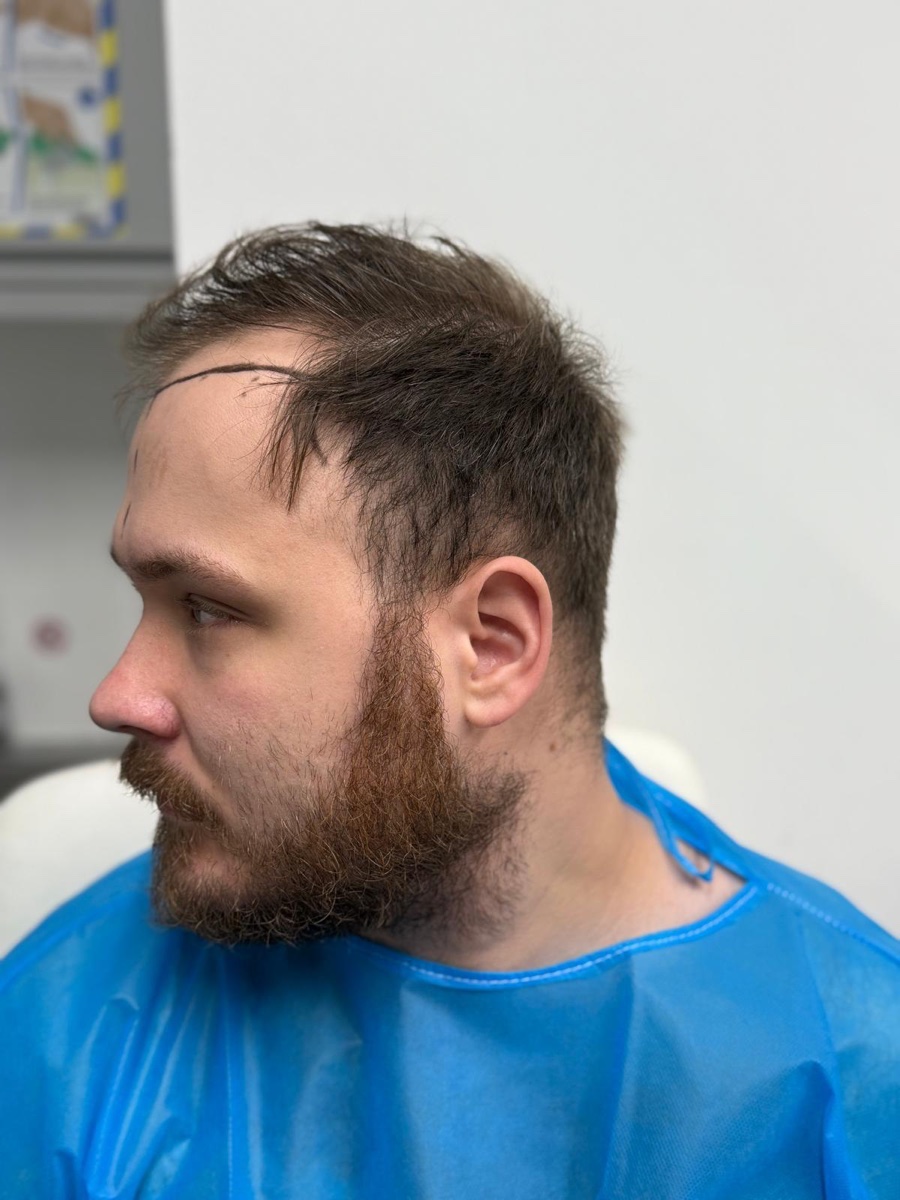 A planned hairline marked before a hair transplant